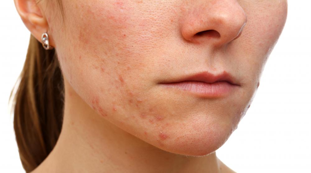Purifying masks are used to deal with acne breakouts.