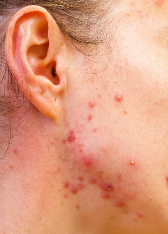 Acne may be treated with evening primrose oil.
