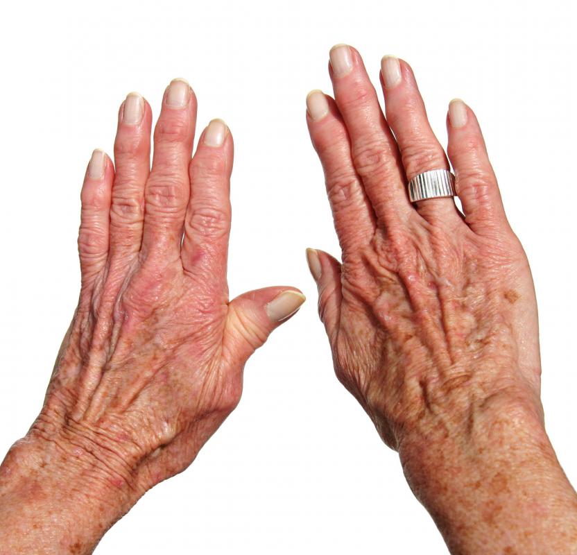 Age spot removers are generally available as creams.