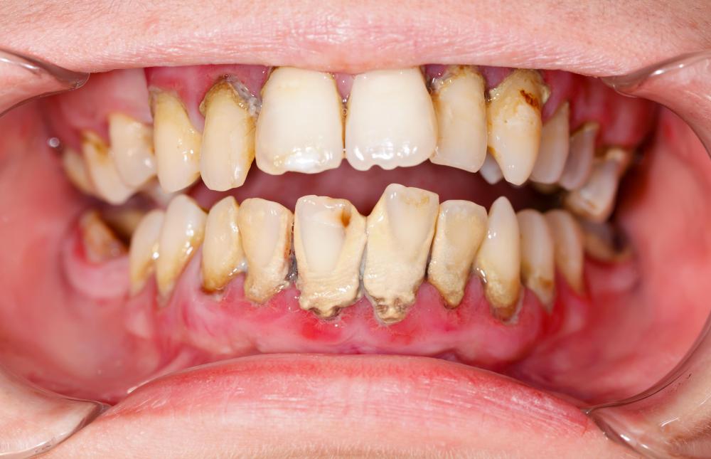 Not changing toothbrushes often enough can make it tougher to remove the plaque that causes tooth decay.