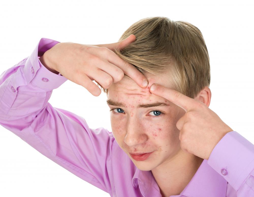 Pimples should not be popped, as this can cause scarring of the skin.