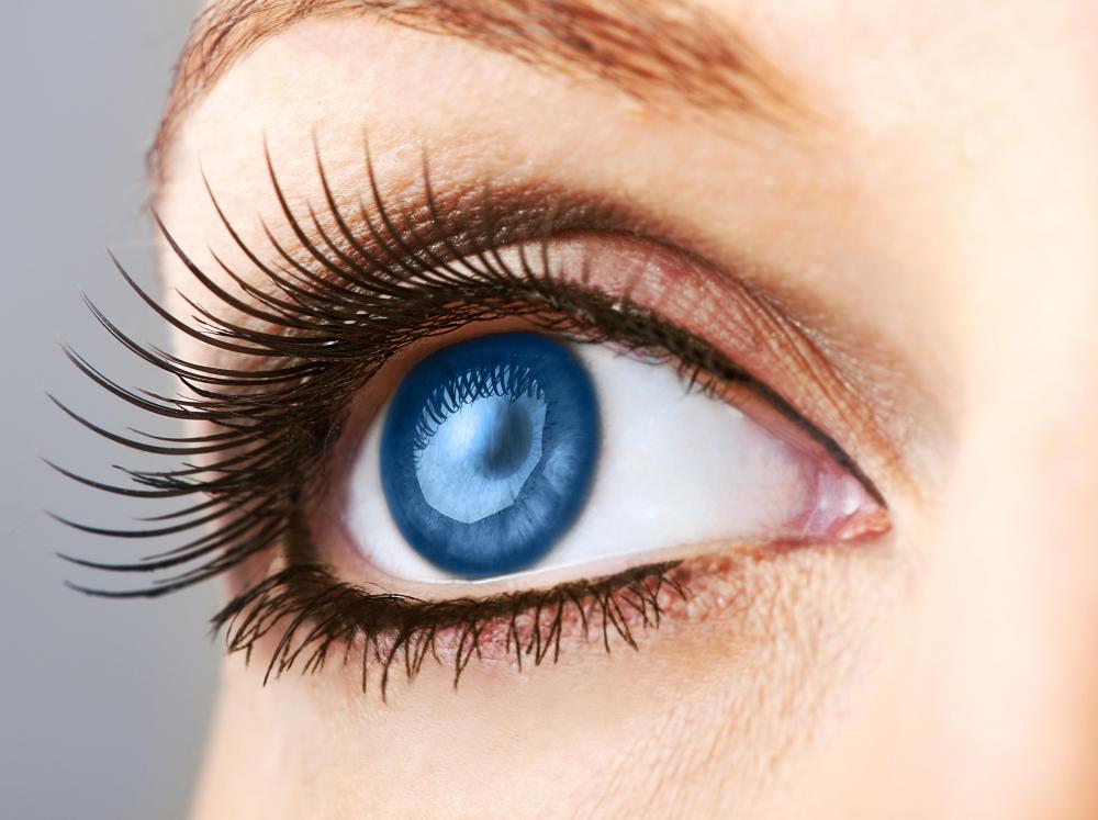 Eye whitening may be performed to reduce the appearance of veins on the white of the eye.
