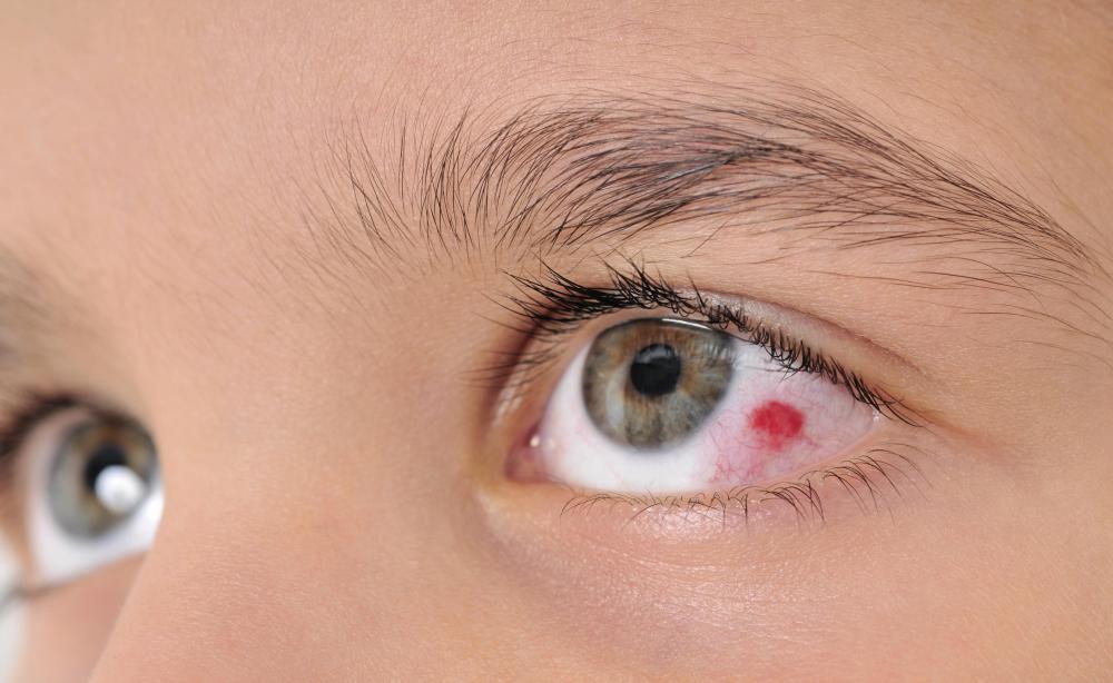 Eyelash perming products have the potential to cause eye infections.