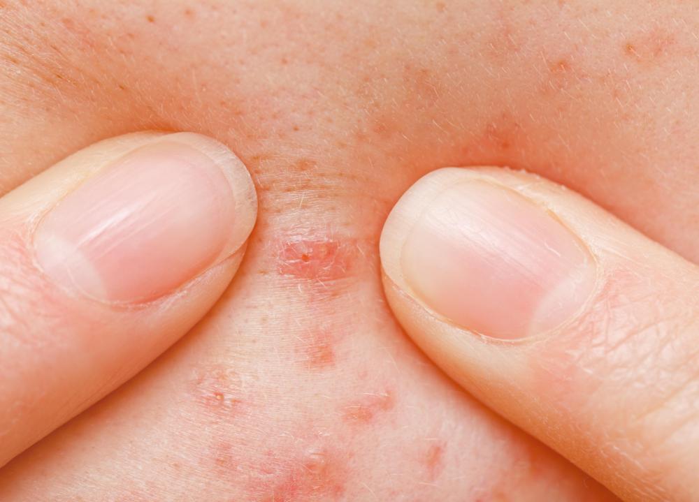 Salicylic acid cream should be used regularly in order to work most effectively.