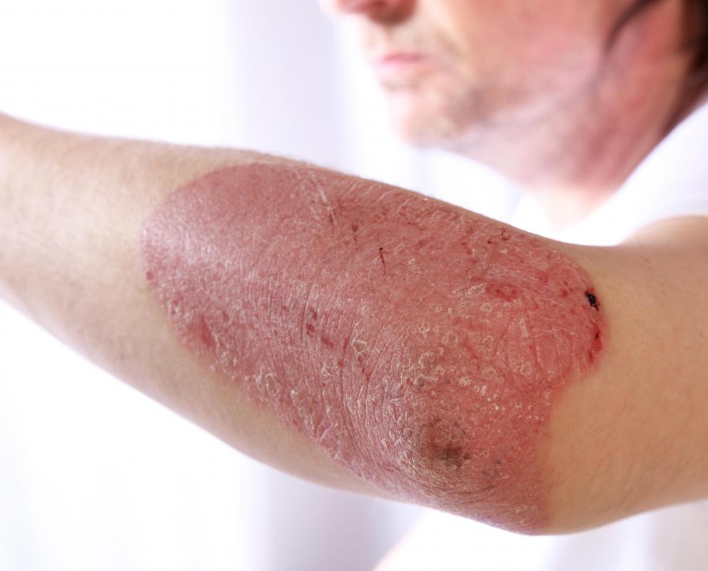 Some patients may find their psoriasis is triggered by certain foods or drinks.