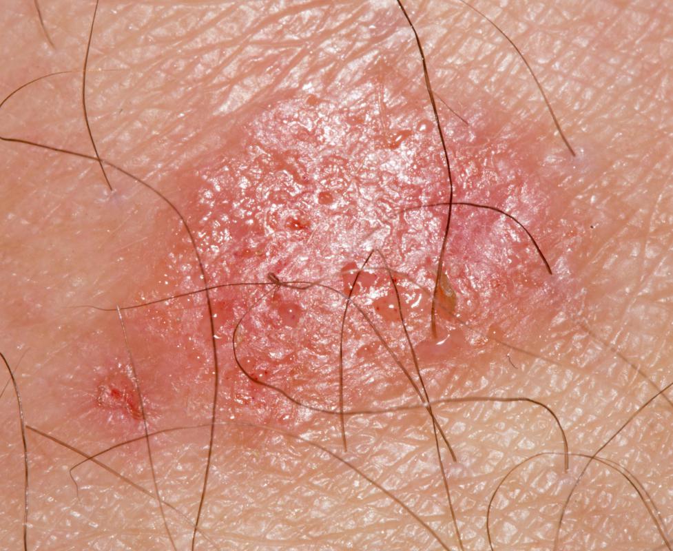 Ringworm is a fungal infection that may be treated with skin zinc.