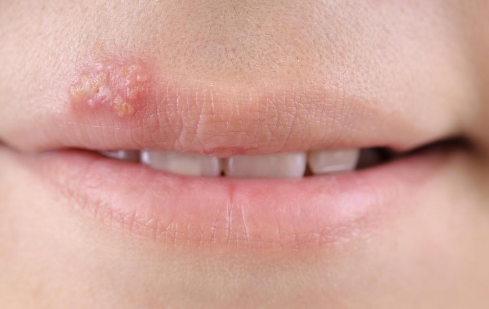 Beeswax lip balm may help prevent cold sores.