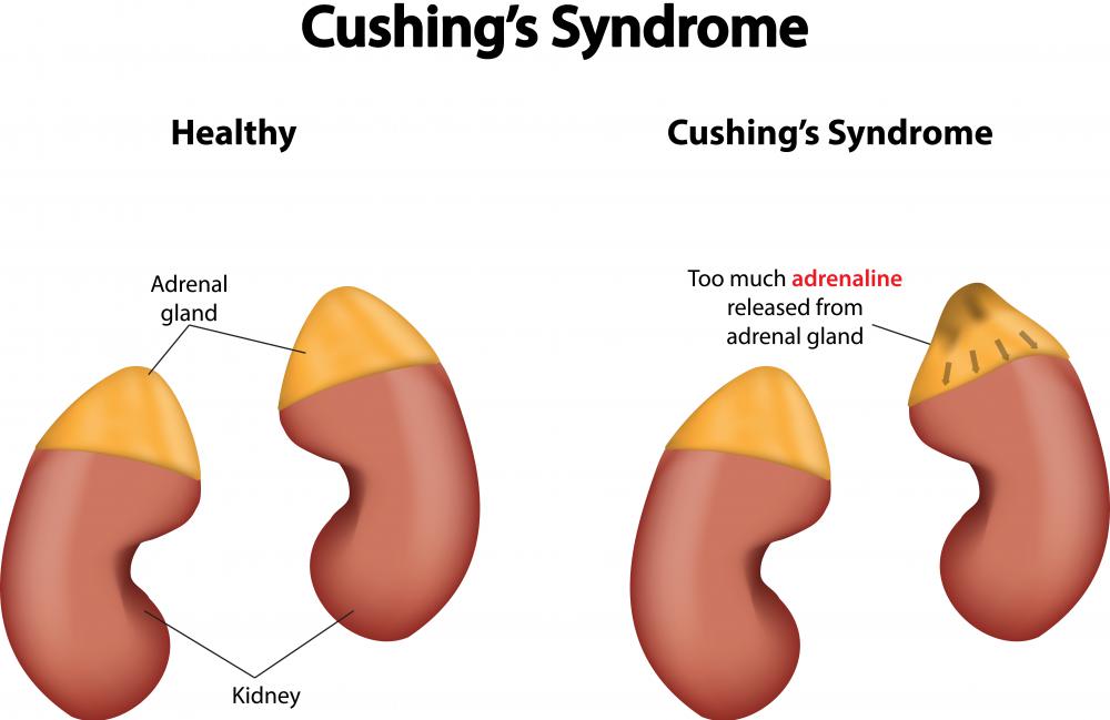 When a woman experiences sudden excessive hair growth, she should consult a doctor as it may be a sign of Cushing's Syndrome.