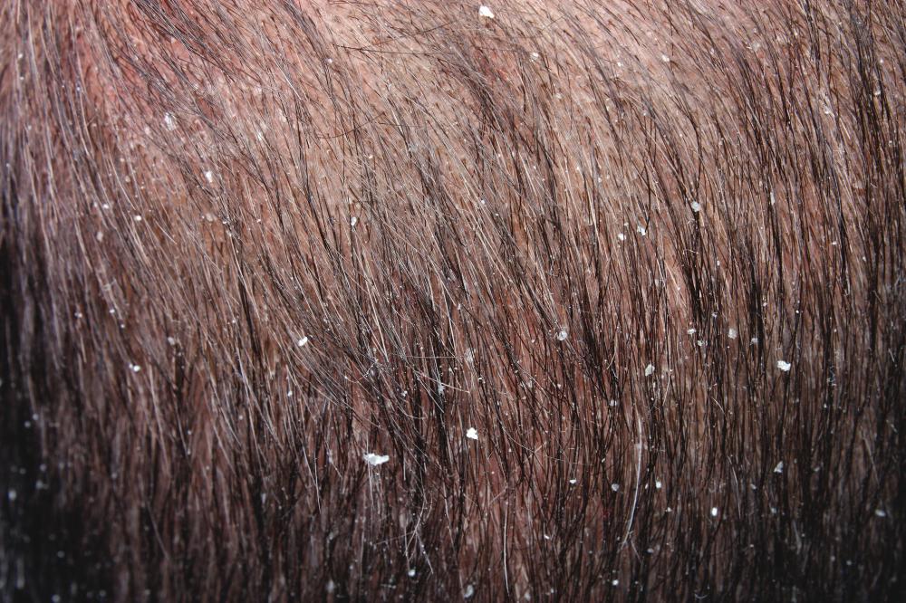 It's a myth that baldness is caused by dandruff.