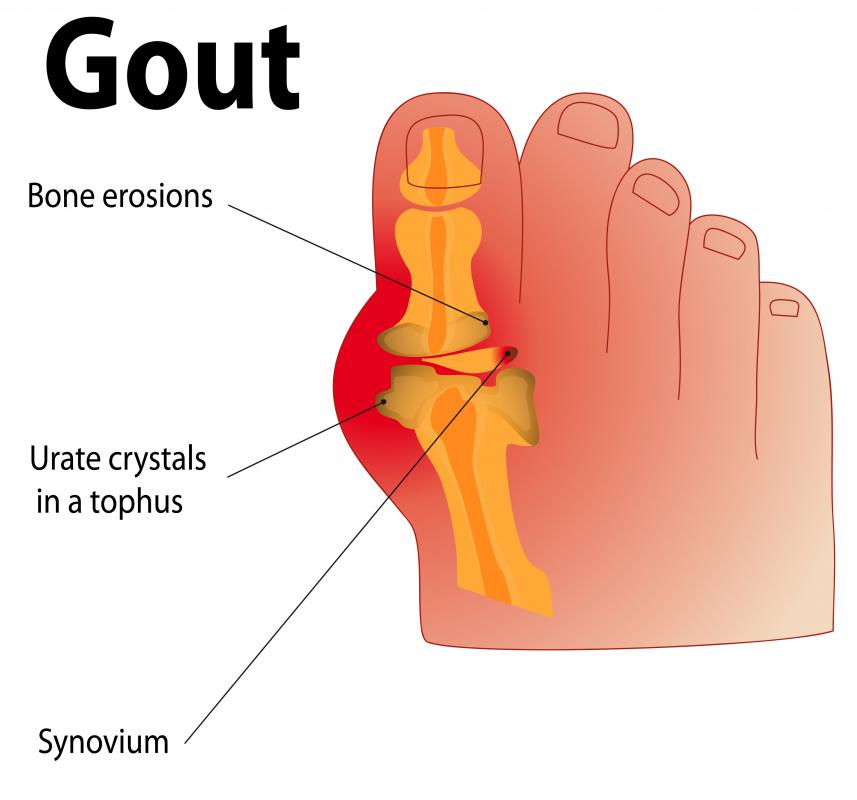 Carrot oil may be used to treat the pain and inflammation associated with gout.