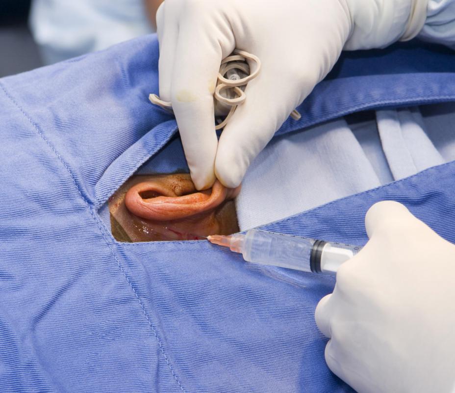 Cosmetic ear surgery typically involves cutting and sewing ear cartilage or the ear lobe.