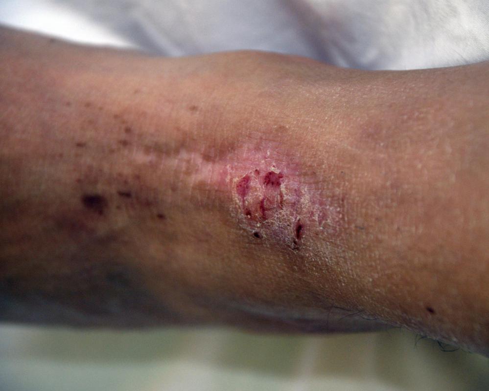Shea butter may be used to treat eczema.