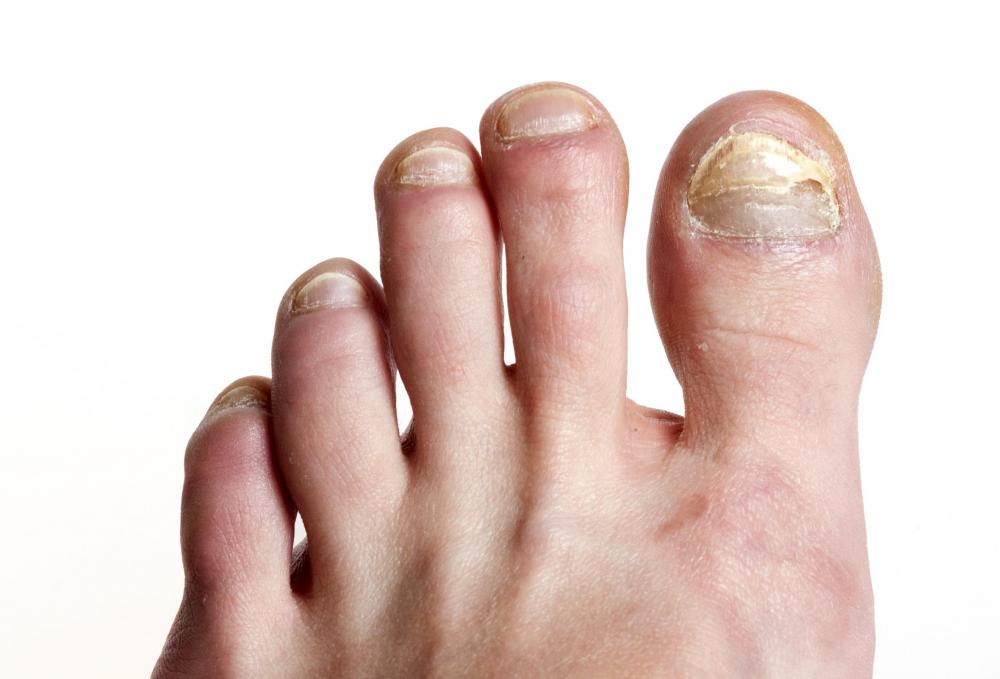 Use of an orange stick may lead to problems with nail fungus.
