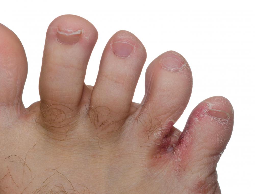 Three drops of tea tree oil and a half cup of olive oil can be used to treat athlete's foot.