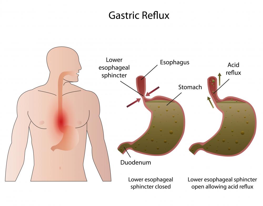 Persistent bad breath may be the cause of an underlying condition like gastric reflux.