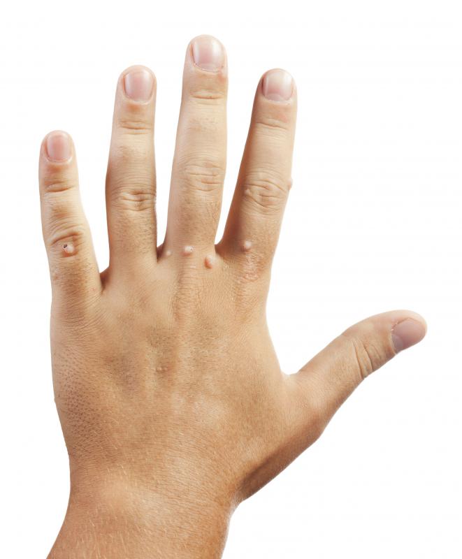Topical salicylic acid can be used to treat warts.