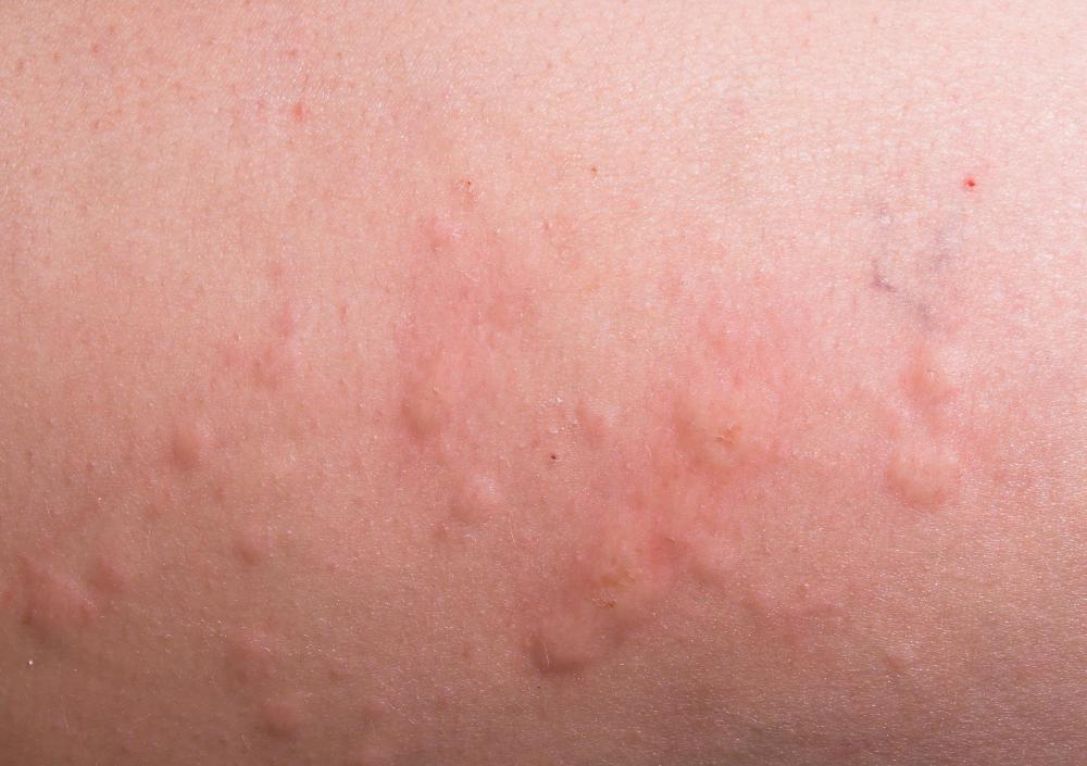 Some individuals may experience hives as part of an allergic reaction to dimethicone.