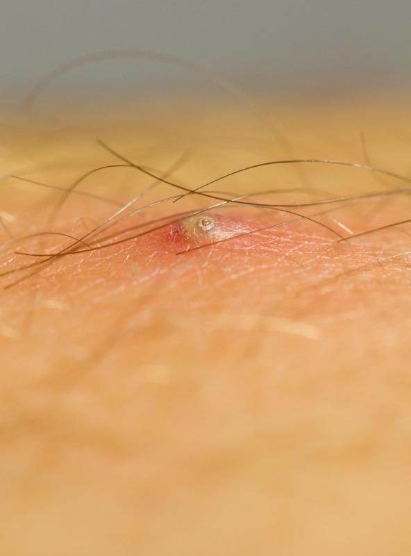 A razor bump can turn into an ingrown hair if the hair gets stuck in the follicle.