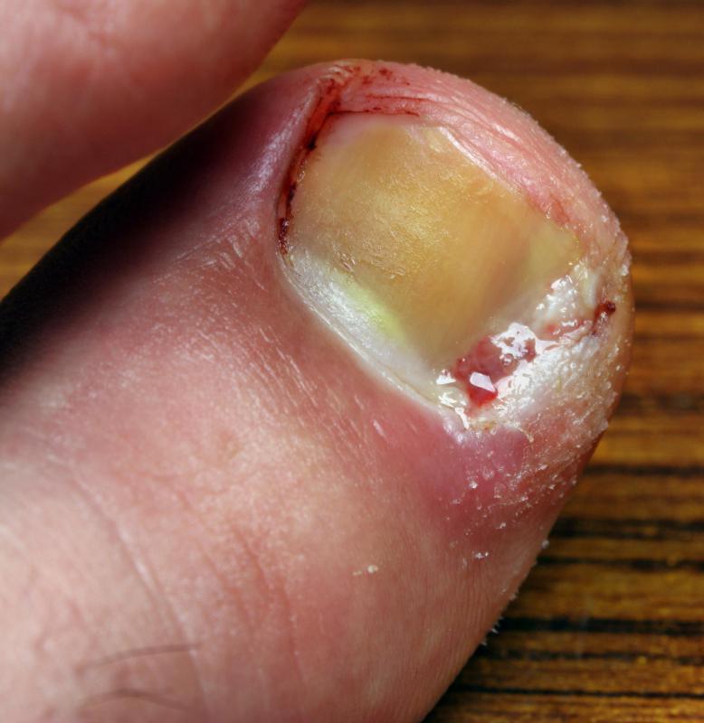 The wrong toenail file, or using one the wrong way, can lead to an ingrown toenail.