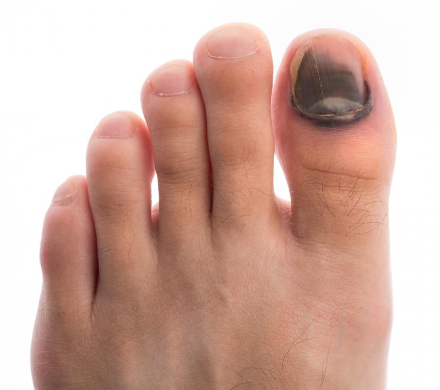 Injured toenails typically grow at a slower rate than healthy ones.