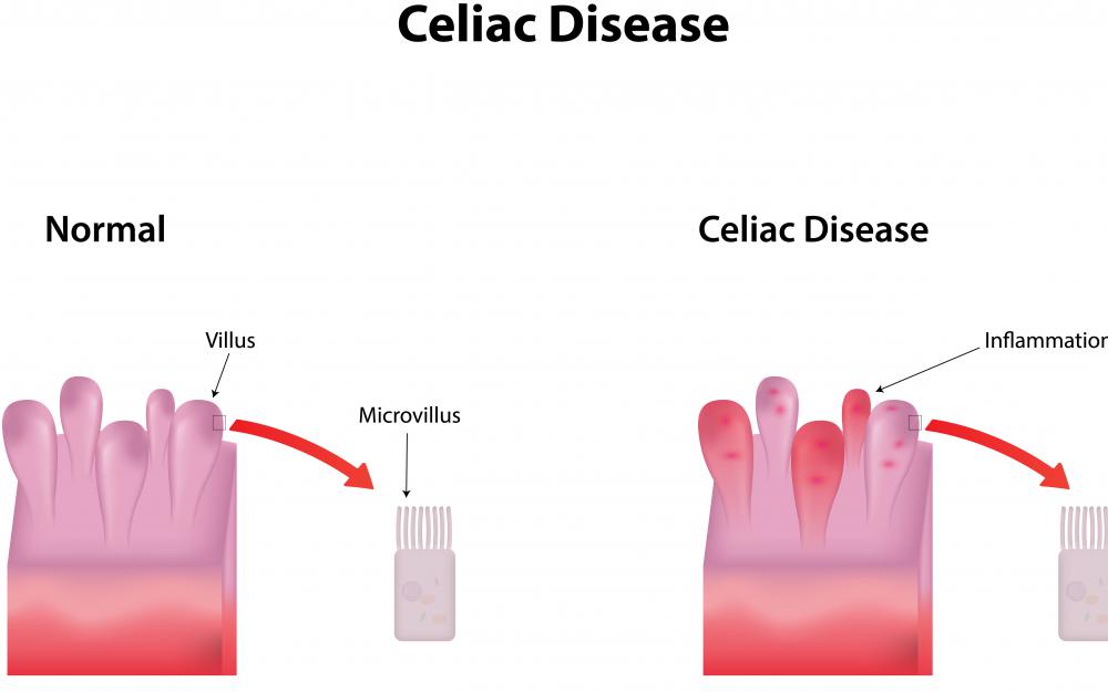 The diet for someone with celiac disease may be useful for someone with psoriasis.