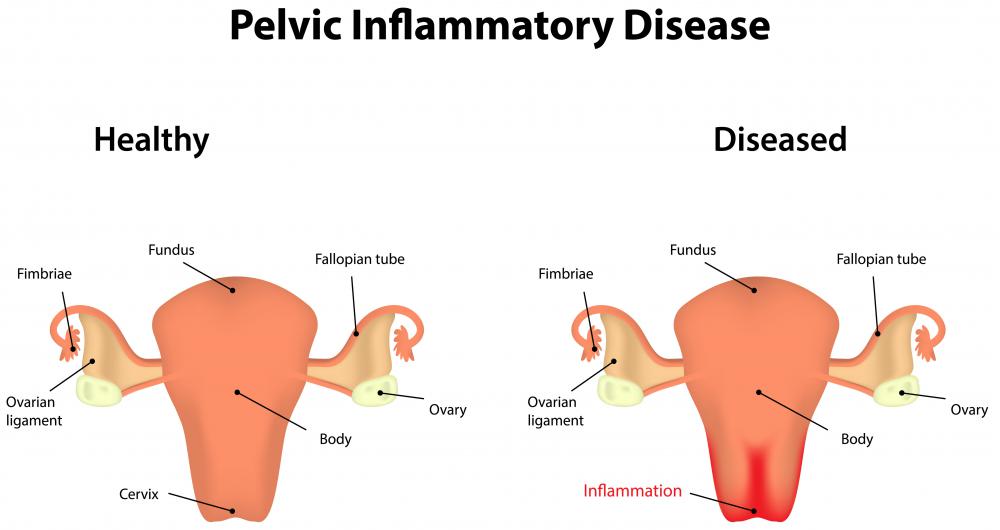 Douching may lead to serious issues like pelvic inflammatory disease.