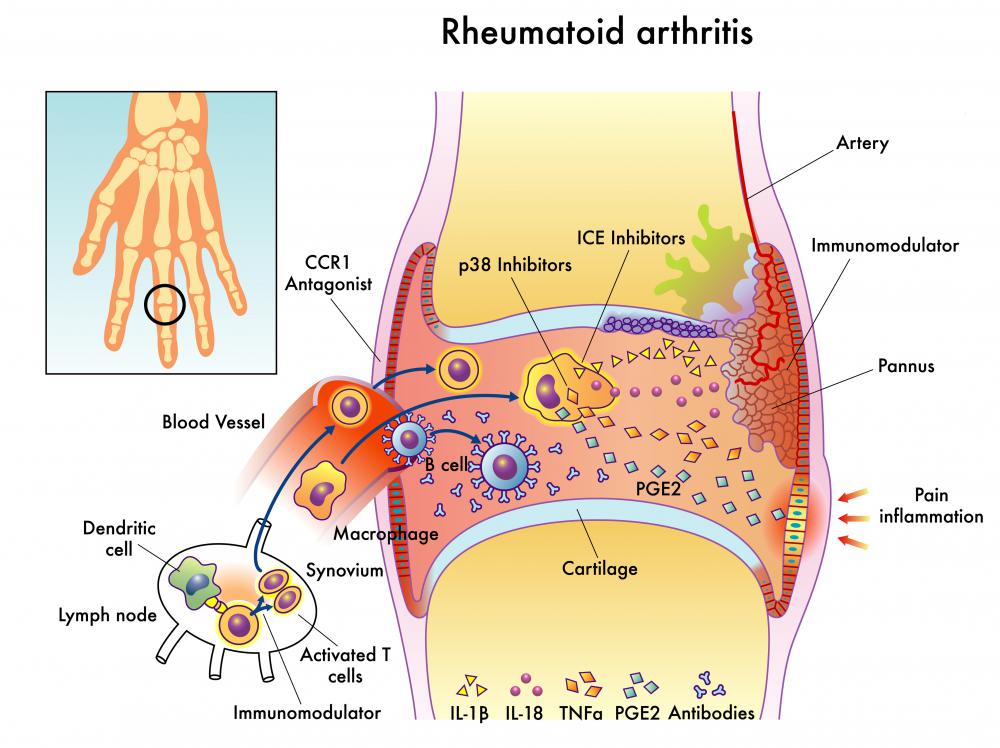 Chicken collagen may be useful for treating rheumatoid arthritis.