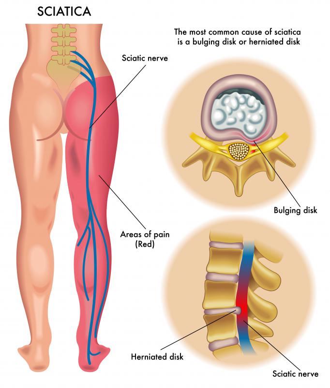 A mud treatment known as peloid therapy may offer relief for problems with the sciatic nerve, which can cause pain and numbness down the leg.