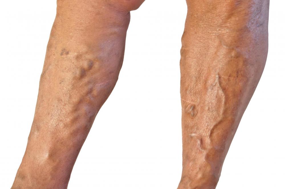 Horse chestnut cream can be used to reduce the appearance of varicose veins.