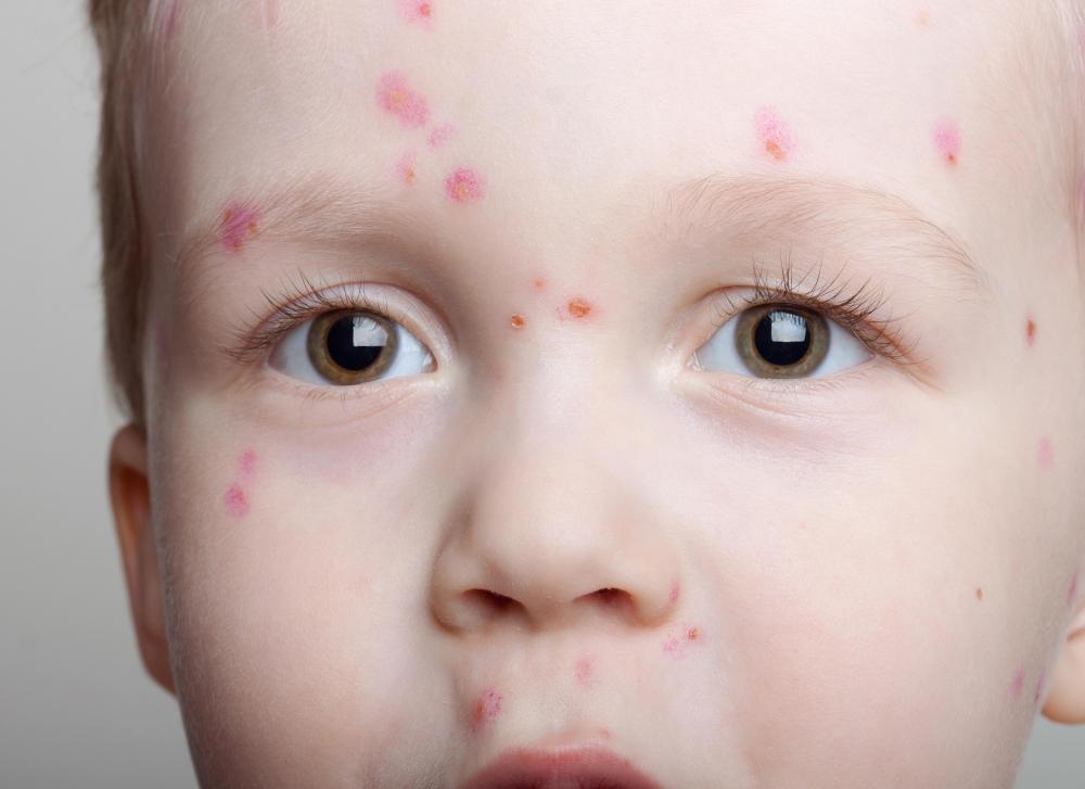 A tea tree oil bath can be soothing for those suffering from chicken pox.