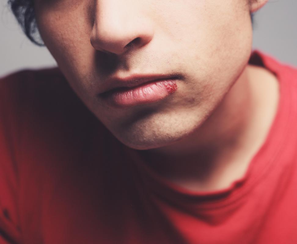 People with active cold sores should avoid lip injections.