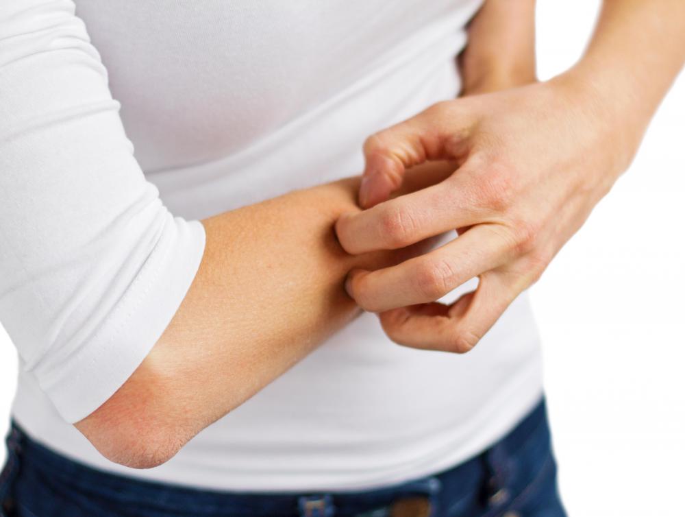 Treatment side effects may include skin irritation, including redness or itching.