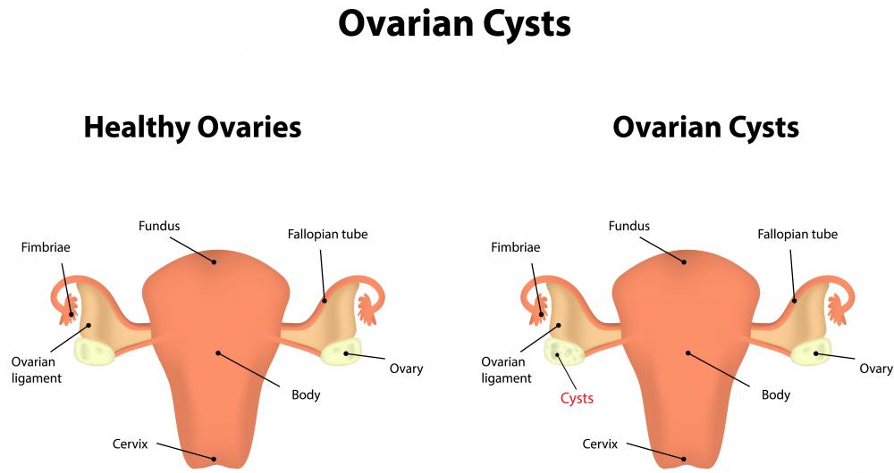 Squalane has been found in ovarian cysts.