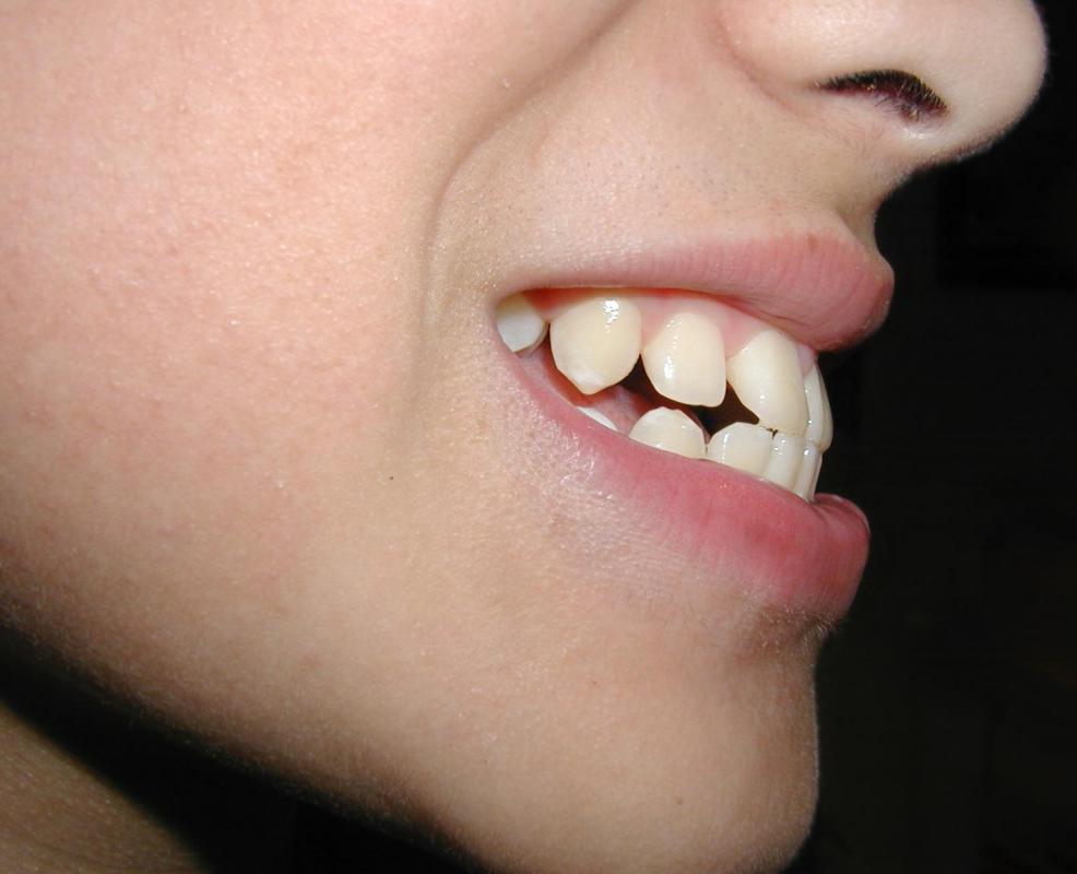 A dental condition that causes a misalignment of the jaw may be referred to as an overbite.
