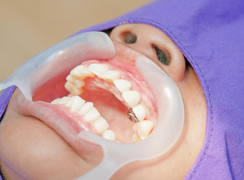 Professional teeth whitening treatments are often much more effective than pens or other home methods.