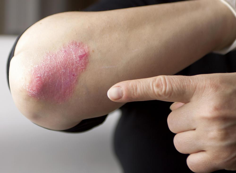 The scalp and many other parts of the body can be affected by psoriasis.