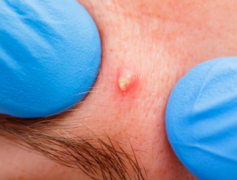 Whiteheads may form on the surface of the skin on the face.