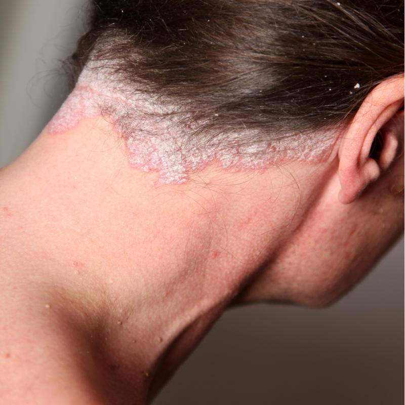 Psoriasis is an uncomfortable and painful disease.