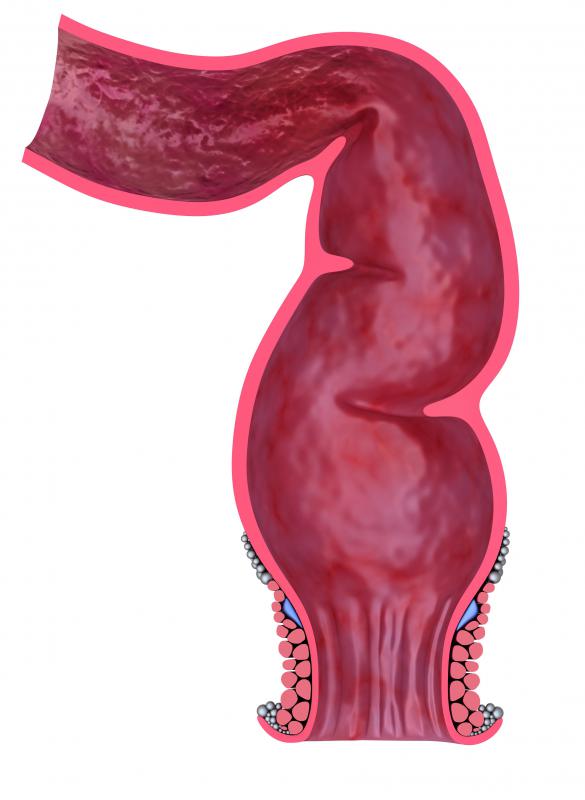 A rectal douche involves the insertion of liquid into the rectum to empty the bowels.