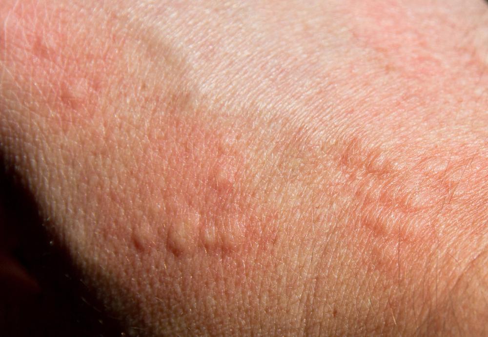 Hydroquinone cream reactions could include hives.