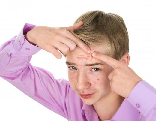Pimples should not be popped, as this can cause scarring of the skin.