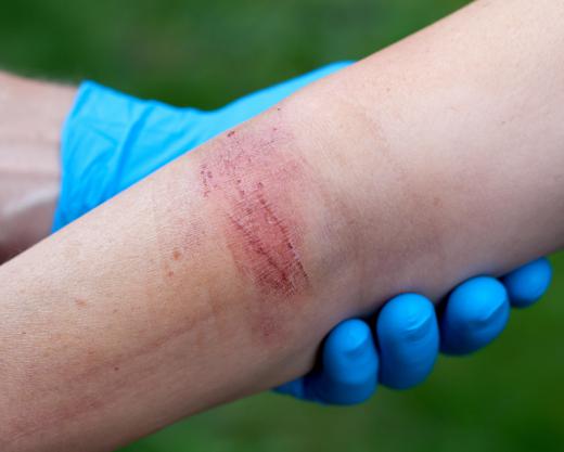 Bitter almond oil may be applied to the skin to treat surface skin infections.