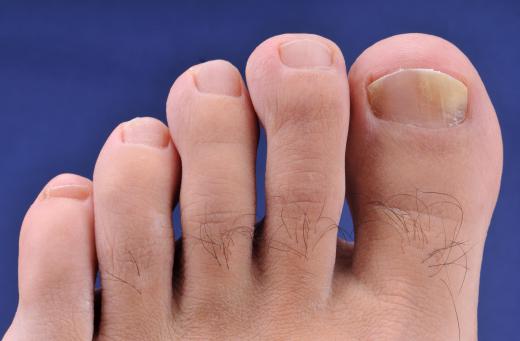 Fungus may become an issue with artificial toenails.