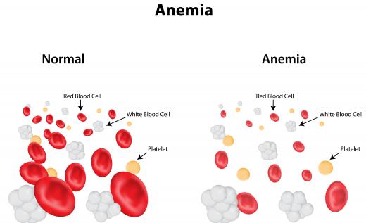Anemia can contribute to gray hair as a result of an iron deficiency in the blood.