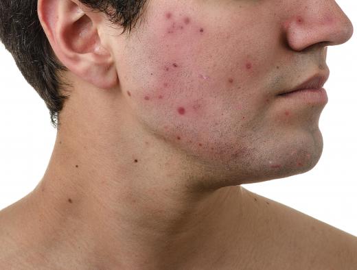 Microdermabrasion may be helpful in reducing the appearance of acne scars.