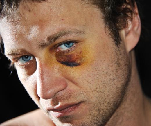 Vitamin K cream can be used to treat bruises around the eye.
