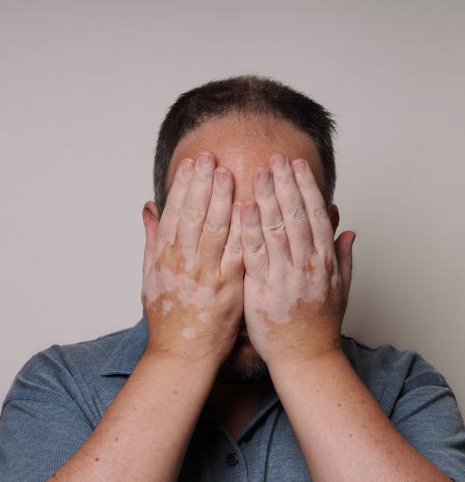 Temporary tattoos may be used to balance the skin tone of a person suffering with vitiligo.