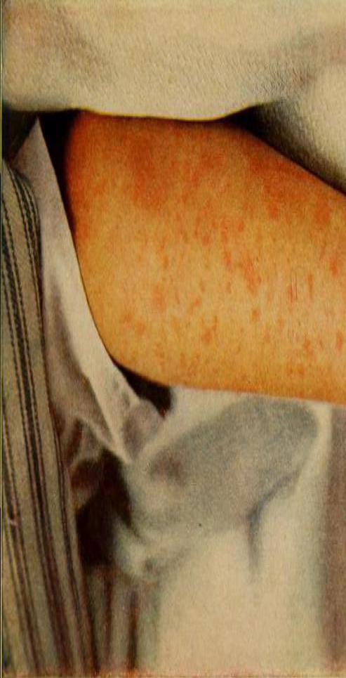 Carrot soap can be used to even out mottled skin tones.
