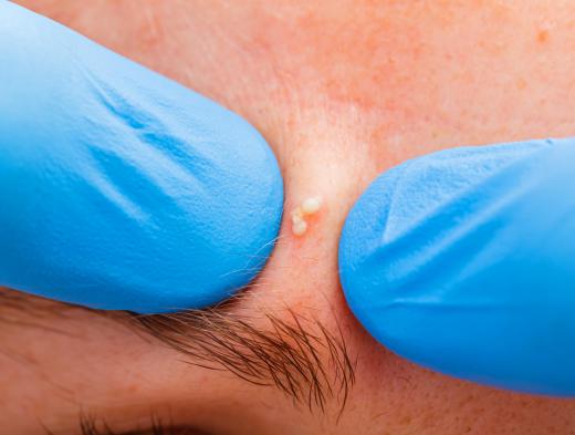 Some people may be tempted to pop dilated pores at home, but the risk of scarring can be greatly reduced when it is done by a doctor.