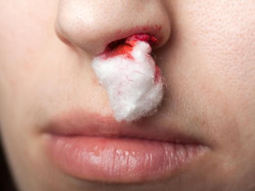 Individuals who are prone to nosebleeds may benefit by using a humidifier during the cold months.